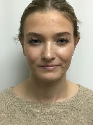 Ear Correction / Otoplasty: Case 6 (CID491370) - After, nop longer needs to wear her hair down