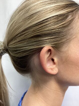 Ear Correction / Otoplasty: Case 6 (CID491370) - Before, right, rim toward camera