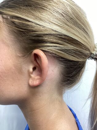 Ear Correction / Otoplasty: Case 6 (CID491370) - Before, left, rim toward camera