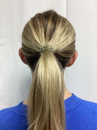 Ear Correction / Otoplasty Case 6 (CID491370) - Before