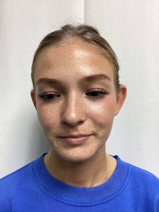 Ear Correction / Otoplasty: Case 6 (CID491370) - Before