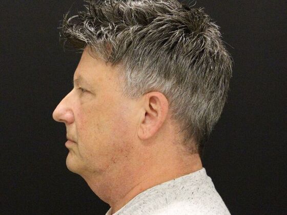 Face & Neck Lifts: Case 52 - Before