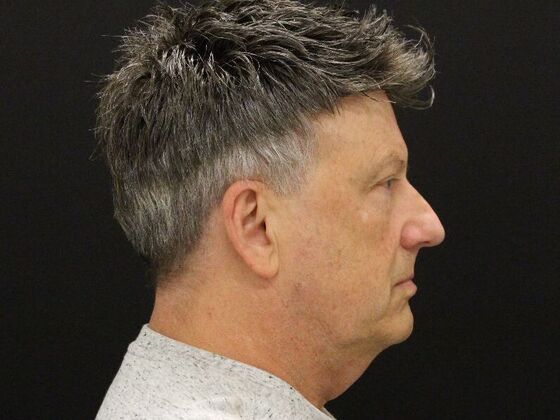 Face & Neck Lifts: Case 52 - Before