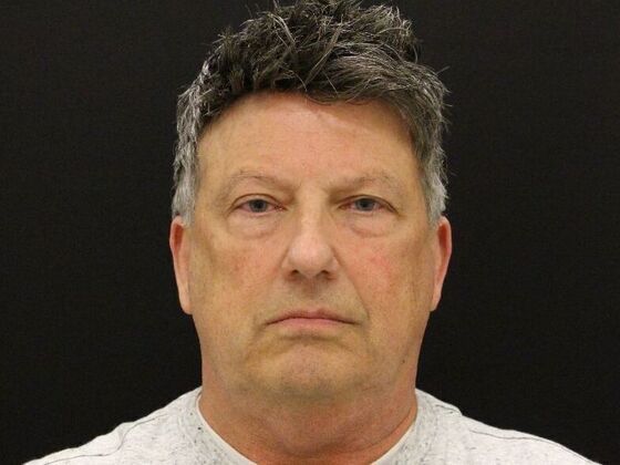 Face & Neck Lifts Case 52 - Before