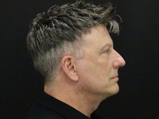 Face & Neck Lifts: Case 52 - After