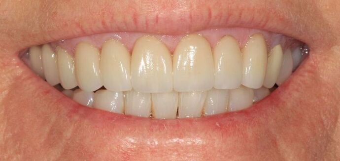Porcelain Veneers Case 30 - After