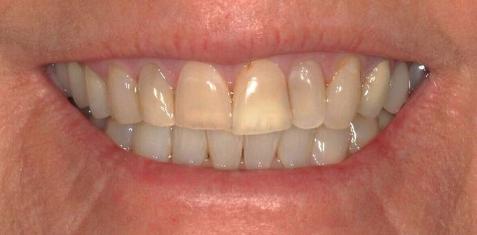 Porcelain Veneers Case 30 - Before