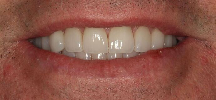 Porcelain Veneers Case 31 - After
