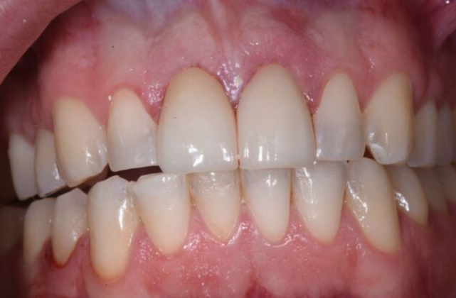 Veneers Case 7 - After
