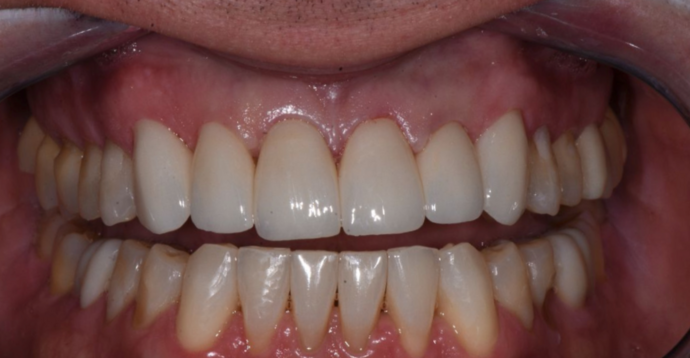 Veneers Case 4 - After