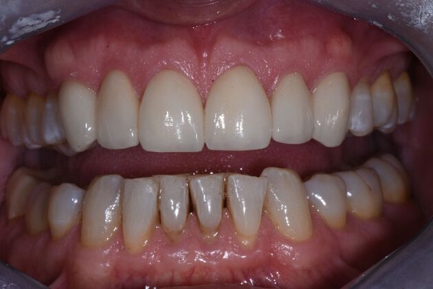 Veneers Case 9 - After