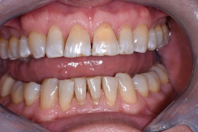 Veneers Case 9 - Before
