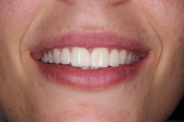 Before and Afters: Christina - After