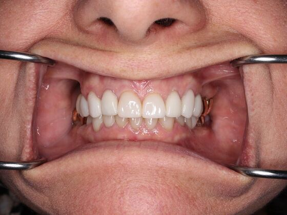 Before and Afters Darlene - After