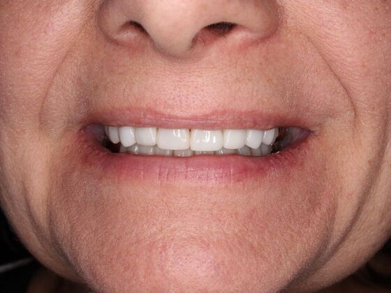 Before and Afters: Darlene - After