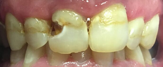 Before and Afters Robert  - Before