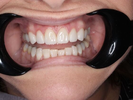 Before and Afters Sharon - After