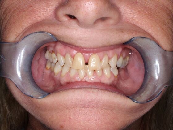 Before and Afters Tina - Before