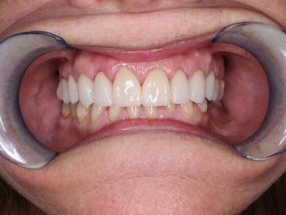 Before and Afters Tina - After