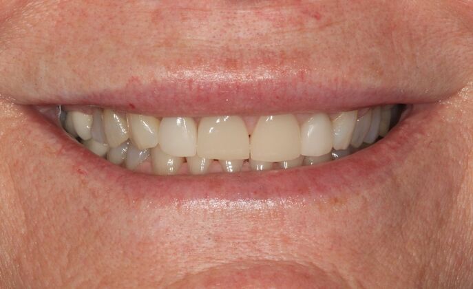 Full Mouth Reconstruction: Case 44 - Before