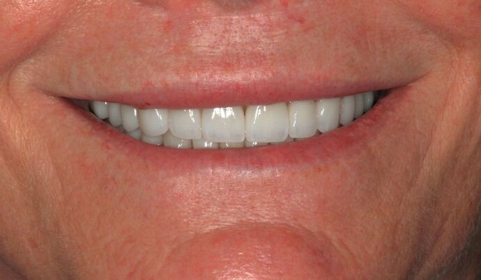 Full Mouth Reconstruction: Case 44 - After