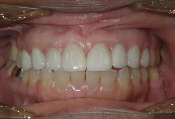 Cosmetic Changes with Veneers and Crown and Bridge: Closing spaces and masking discolored teeth. - After