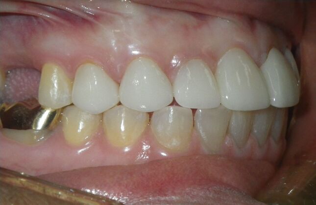 Cosmetic Changes with Veneers and Crown and Bridge: Closing spaces and masking discolored teeth. - After