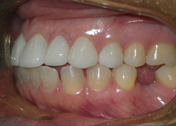Cosmetic Changes with Veneers and Crown and Bridge: Closing spaces and masking discolored teeth. - After