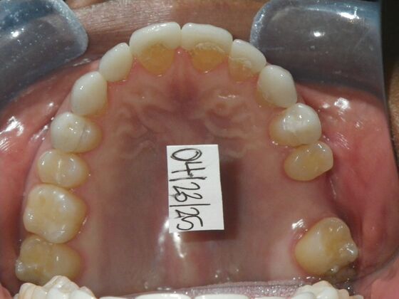 Cosmetic Changes with Veneers and Crown and Bridge: Closing spaces and masking discolored teeth. - After