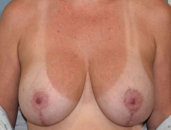 Breast Revision: Case 283 - After