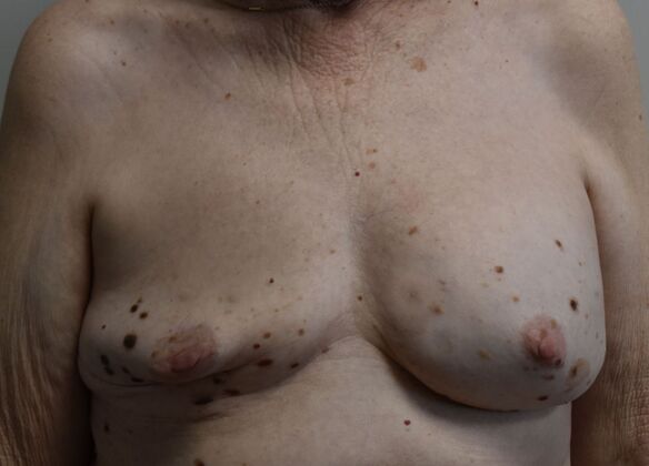 Breast Revision: Case 285 - Before