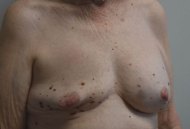 Breast Revision: Case 285 - Before