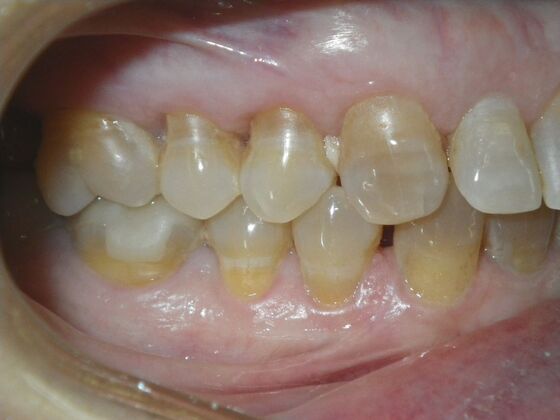 Cosmetic Changes with Veneers and Crown and Bridge: Case 1 - Before