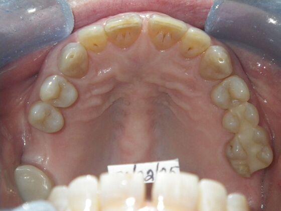 Cosmetic Changes with Veneers and Crown and Bridge: Case 1 - Before