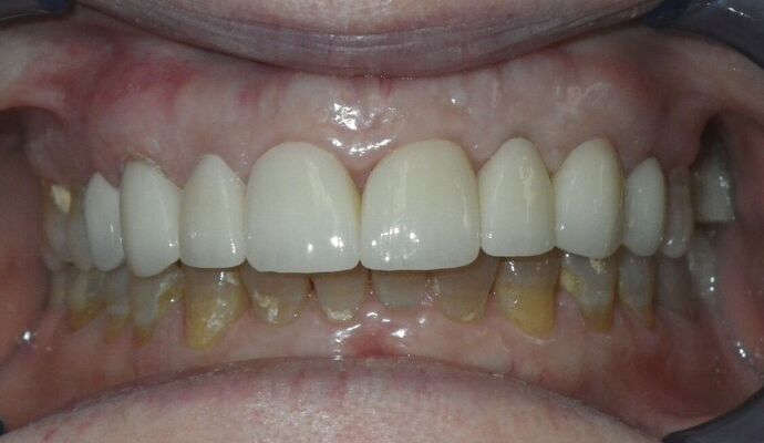 Cosmetic Changes with Veneers and Crown and Bridge: Case 1 - After