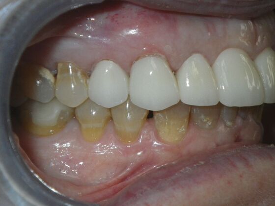 Cosmetic Changes with Veneers and Crown and Bridge: Case 1 - After