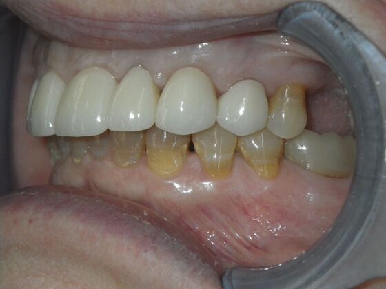 Cosmetic Changes with Veneers and Crown and Bridge: Case 1 - After