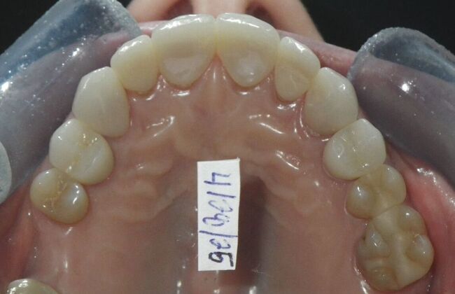 Cosmetic Changes with Veneers and Crown and Bridge: Case 1 - After