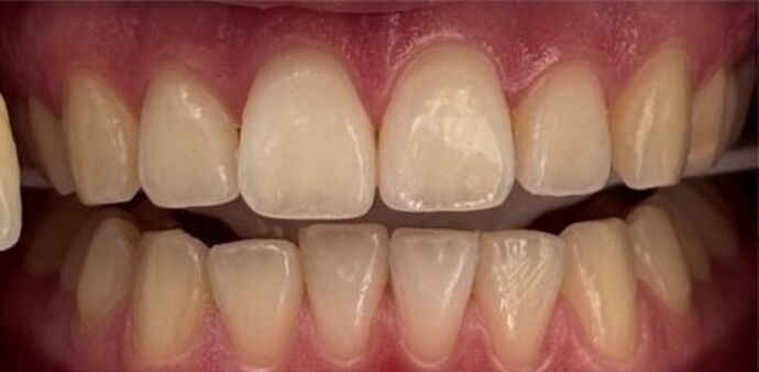 Teeth Whitening Case 1 - Before
