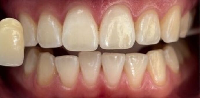 Teeth Whitening Case 1 - After