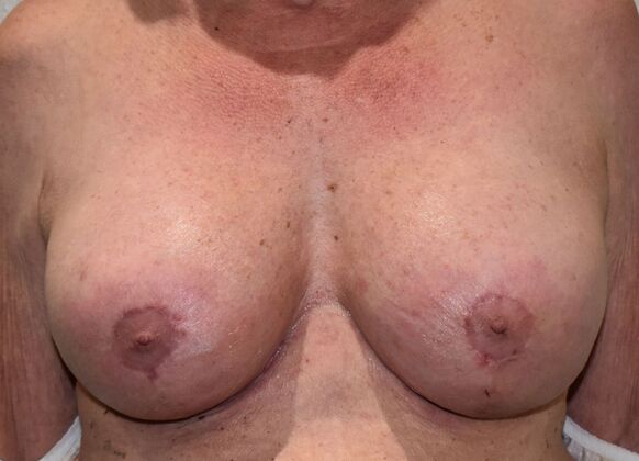 Breast Revision: Case 286 - After