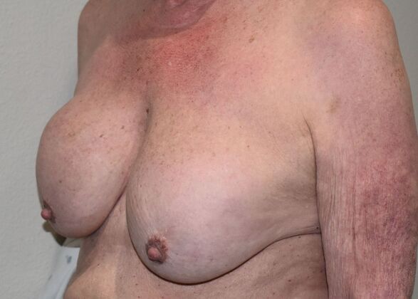 Breast Revision: Case 286 - Before