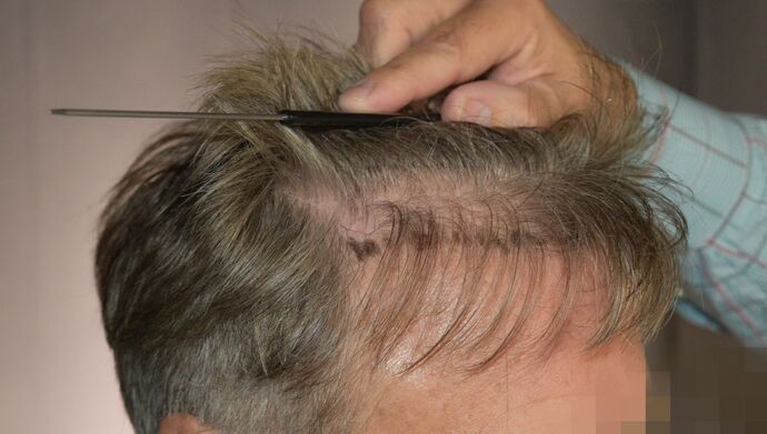 FUT Hair Restoration: Case 51 - Before