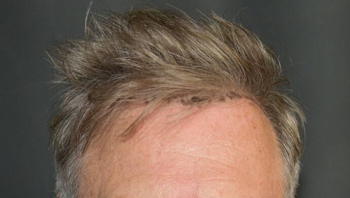 FUT Hair Restoration Case 51 - Before