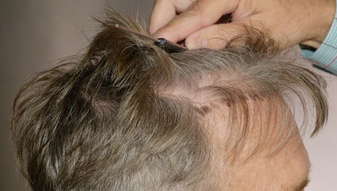 FUT Hair Restoration: Case 51 - Before