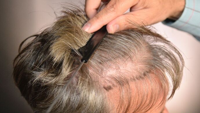 FUT Hair Restoration: Case 51 - Before