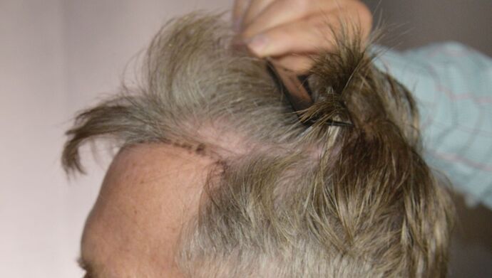 FUT Hair Restoration: Case 51 - Before