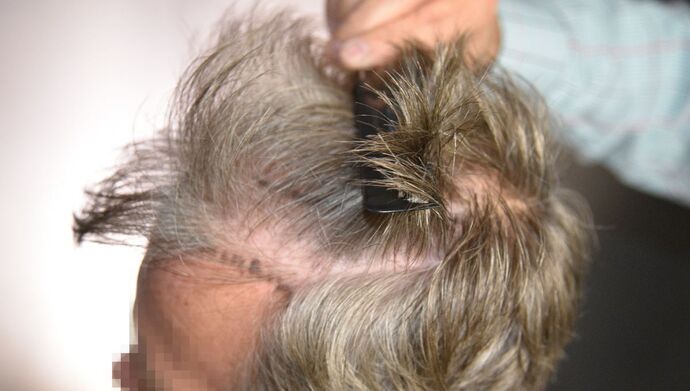 FUT Hair Restoration: Case 51 - Before