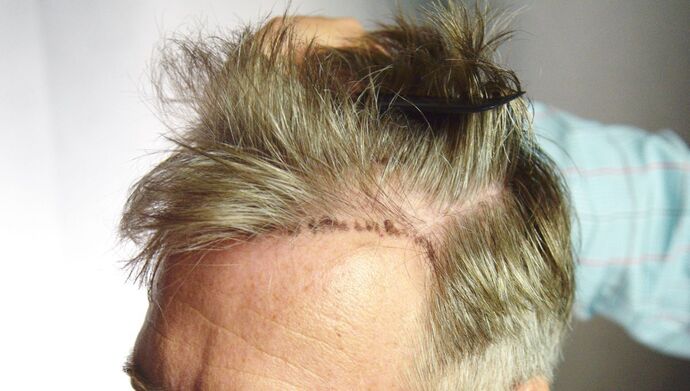 FUT Hair Restoration: Case 51 - Before