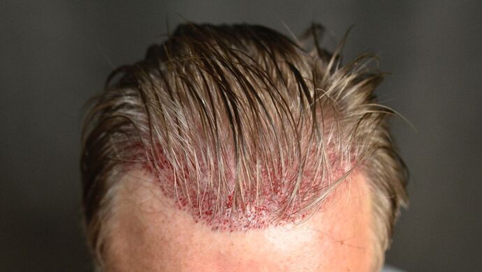 FUT Hair Restoration: Case 51 - Before